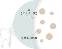 色素沈着で歯が黄ばんだ状態