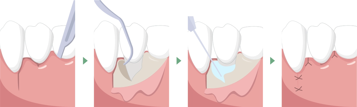 歯周外科治療