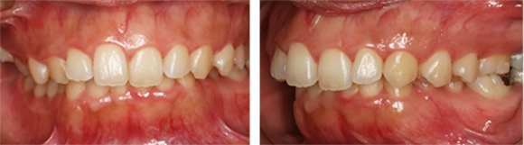出っ歯とディープバイトの治療