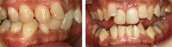 乱抗歯・八重歯の治療