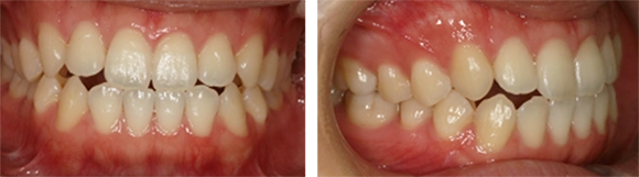 オープンバイト・噛み合わせの治療