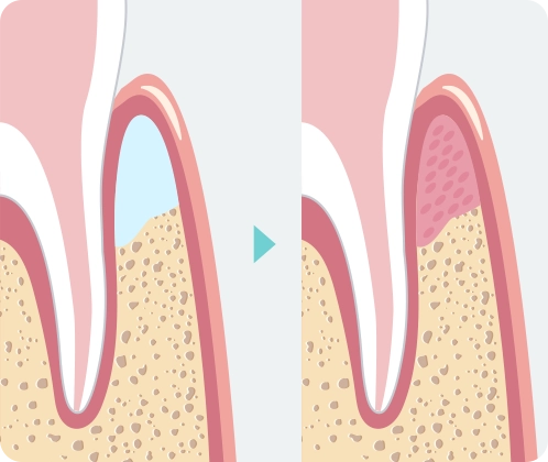 歯周再生治療
